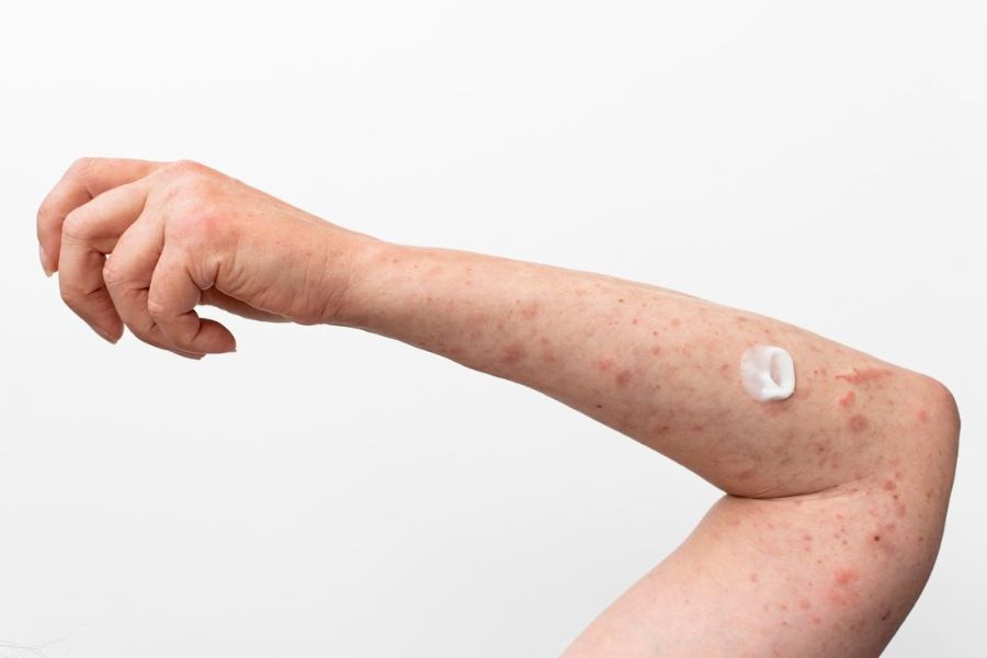 Một số nguyên nhân phổ biến gây ra tình trạng nổi mụn bắp tay Một số nguyên nhân phổ biến gây ra tình trạng nổi mụn bắp tay