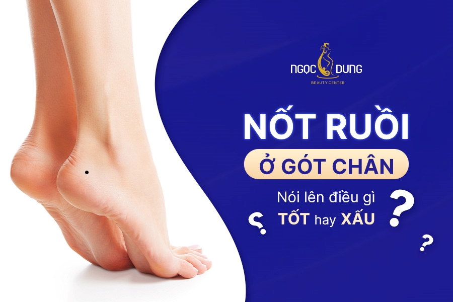 Ý nghĩa nốt ruồi ở gót chân: Cuộc đời giàu sang hay nghèo khổ