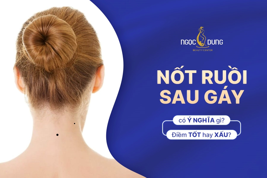 Nốt ruồi sau gáy nam, nữ có ý nghĩa gì? Phước hay là họa?