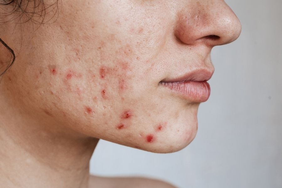 TCA peel là gì? Peel da bằng TCA có tốt không? 6 TCA peel giúp làm mờ các vết thâm cứng đầu thông qua cơ chế ức chế sản sinh melanin