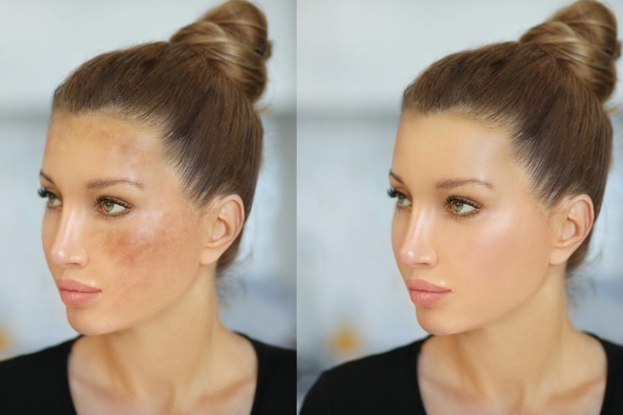 TCA peel là gì? Peel da bằng TCA có tốt không? 5 TCA peel trị nám