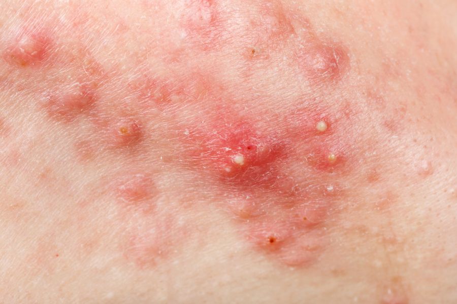 Triệu chứng, dấu hiệu nhận biết mụn trứng cá phát ban
