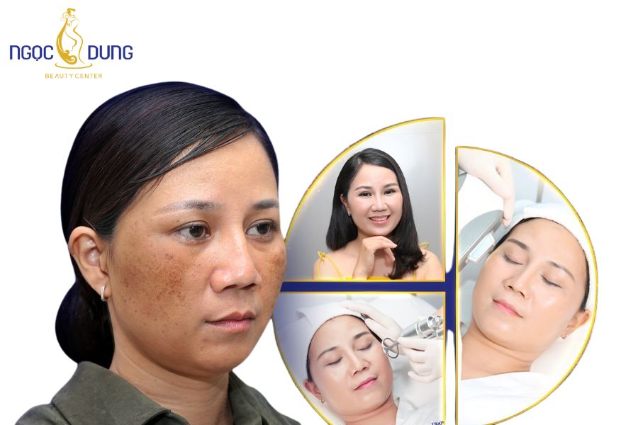 Hình ảnh khách hàng sở hữu làn da sáng mịn, không tì vết sau liệu trình trị nám da chuyên sâu Hình ảnh khách hàng sở hữu làn da sáng mịn, không tì vết sau liệu trình trị nám da chuyên sâu