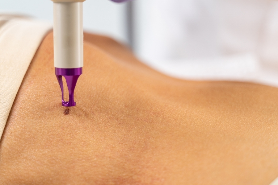 Xóa nốt ruồi trên ngực thường không đau Xóa nốt ruồi trên ngực thường không đau