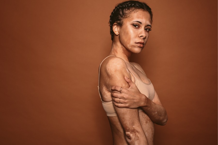 Có hai loại rối loạn sắc tố da thường gặp là tăng sắc tố và giảm sắc tố