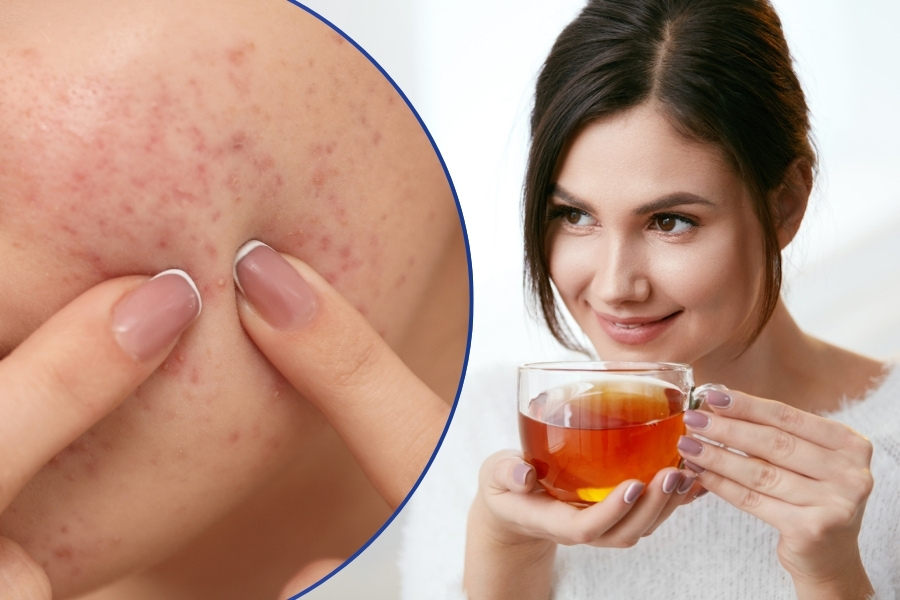 Thực hư câu chuyện uống trà có nổi mụn không