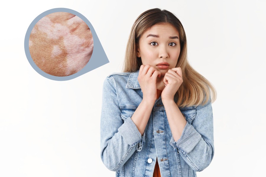 Tình trạng rối loạn sắc tố da có chữa được hay không còn phụ thuộc vào loại rối loạn sắc tố mà bạn đang gặp phải