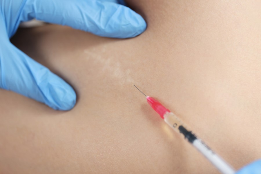 Sẹo lồi tự mọc được không? Làm sao để xóa sẹo lồi hiệu quả 4 width=