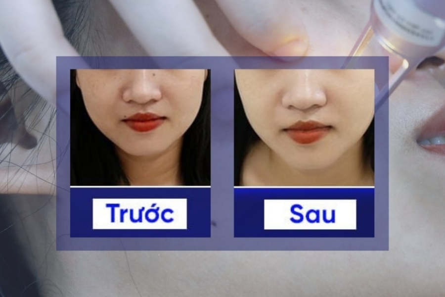 Kết quả tẩy nốt ruồi của khách hàng tại Hệ thống Thẩm mỹ viện Ngọc Dung Kết quả tẩy nốt ruồi của khách hàng tại Hệ thống Thẩm mỹ viện Ngọc Dung