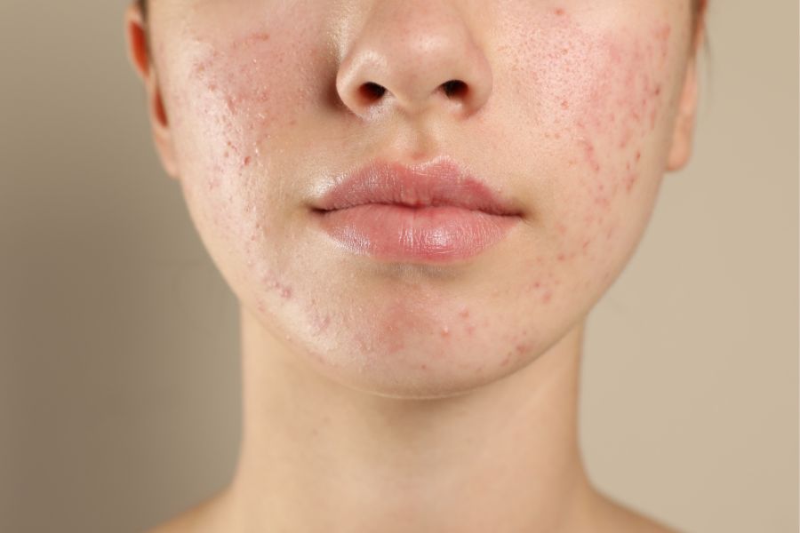 Mụn trứng cá ở cằm là kết quả của quá trình tắc nghẽn lỗ chân lông do sự kết hợp giữa dầu thừa