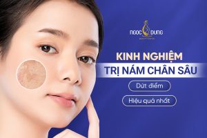 Nám chân sâu là gì? Hiểu đúng để điều trị nám chân sâu tận gốc