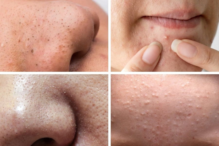 Nhận diện đúng các loại mụn không viêm giúp bạn áp dụng các phương pháp chăm sóc da hiệu quả 