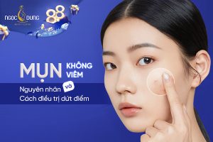 Mụn không viêm là gì? Nguyên nhân và cách điều trị dứt điểm