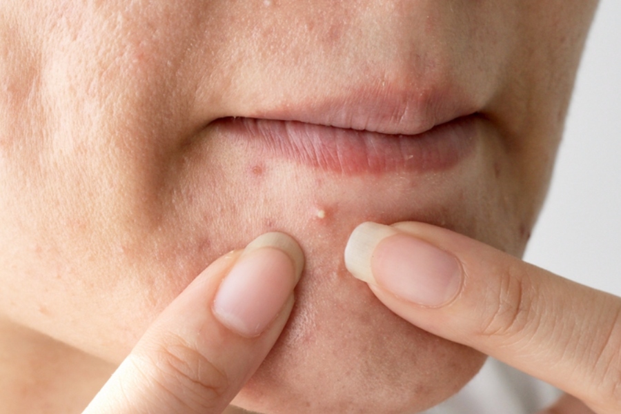 Vì sao nặn mụn xong bị lên mụn đầu trắng? Nặn mụn không kỹ, không đúng kỹ thuật là tác nhân hình thành mụn đầu trắng