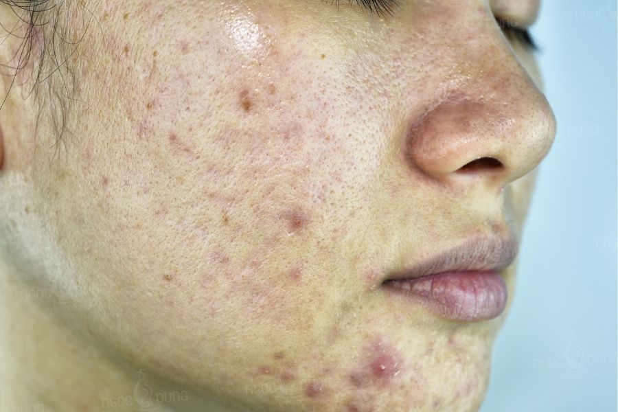 Tại sao mụn thâm dễ bùng phát khi mang thai?