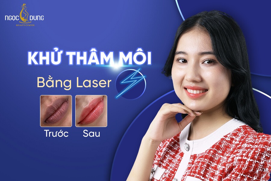 Khử thâm môi là gì? Các phương pháp khử thâm môi phổ biến hiện nay 10 Khử thâm môi bằng Laser được đông đảo khách hàng tin chọn