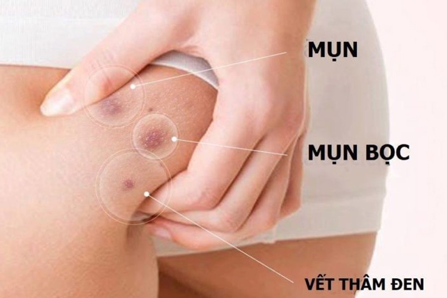 Mụn mọc ở mông dễ chai và tạo ra vết thâm