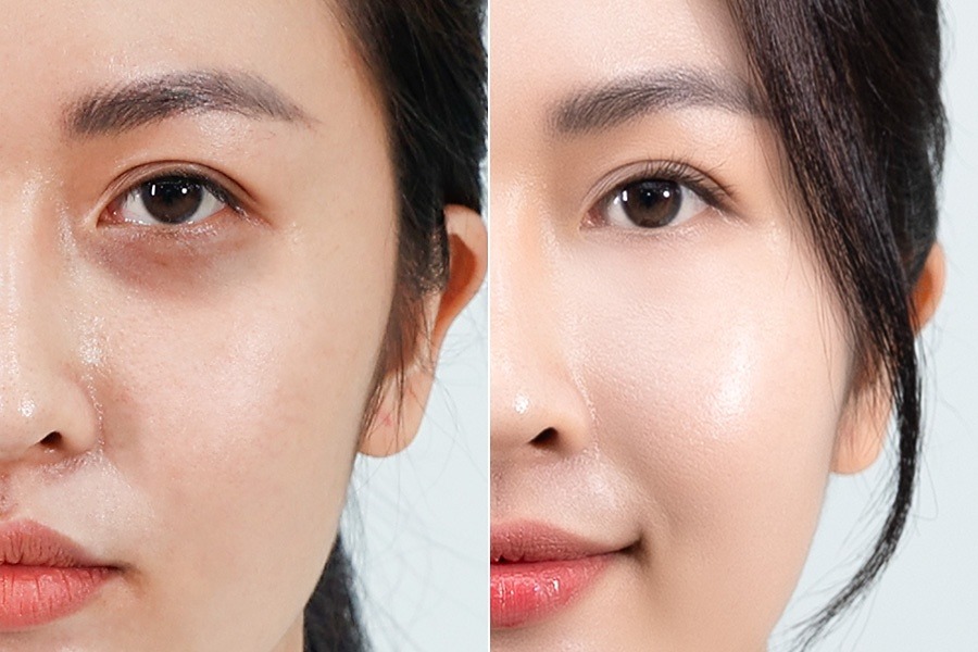 Trị thâm mắt – 5 liệu trình – Tạm biệt vẻ mệt mỏi u ám