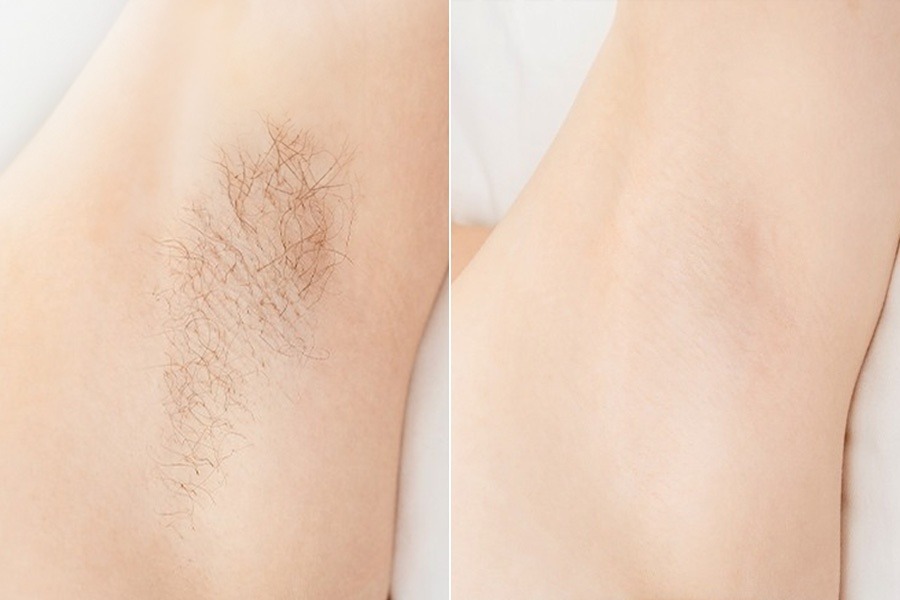 Triệt lông – 3 liệu trình – Da mịn màng khỏe mạnh