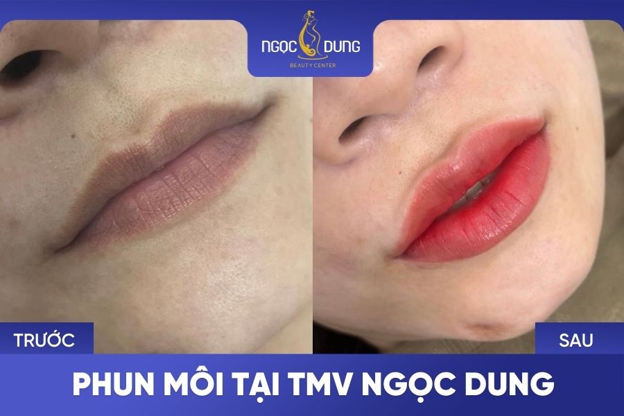 truoc sau phun moi tai Ngoc Dung