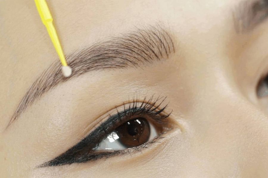 Điêu khắc lông mày bị đứt sợi, mất sợi – Nguyên nhân và cách xử lí 3 Xóa sửa chân mày bằng công nghệ laser tiên tiến