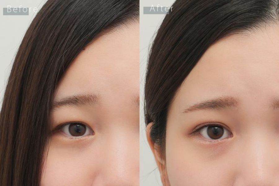 Nhiều phương pháp hiện đại có thể cải thiện mắt mí lót hiệu quả