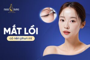 Mắt lồi có nên phun mí không