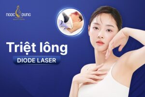 Triệt lông diode laser