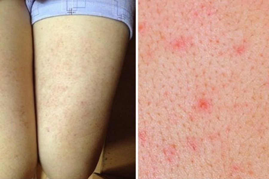 Các vị trí thường bị viêm nang lông chân