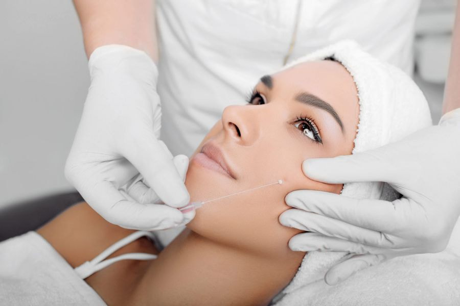 Căng chỉ xóa nhăn có hiệu quả cao hơn các phương pháp botox hoặc filler