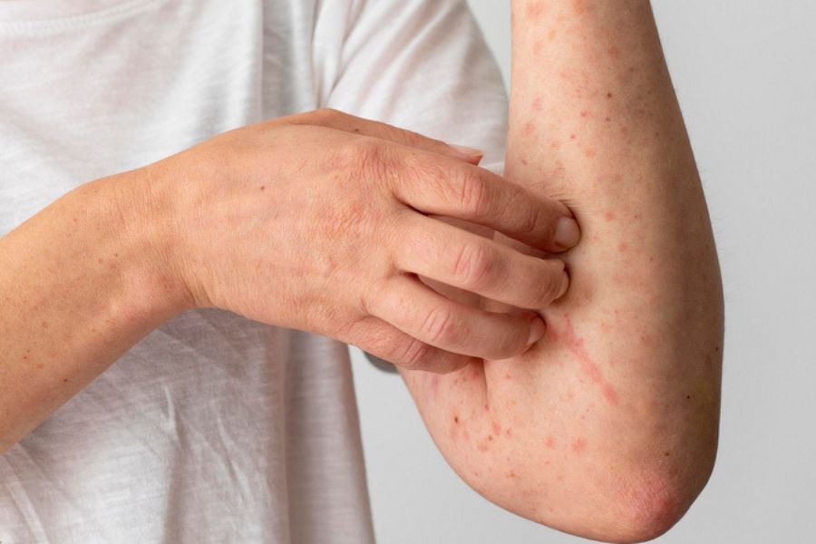 Viêm nang lông có lây không? Các biến chứng khi mắc phải 3 Viêm nang lông gây ngứa ngáy khó chịu, mất thẩm mỹ