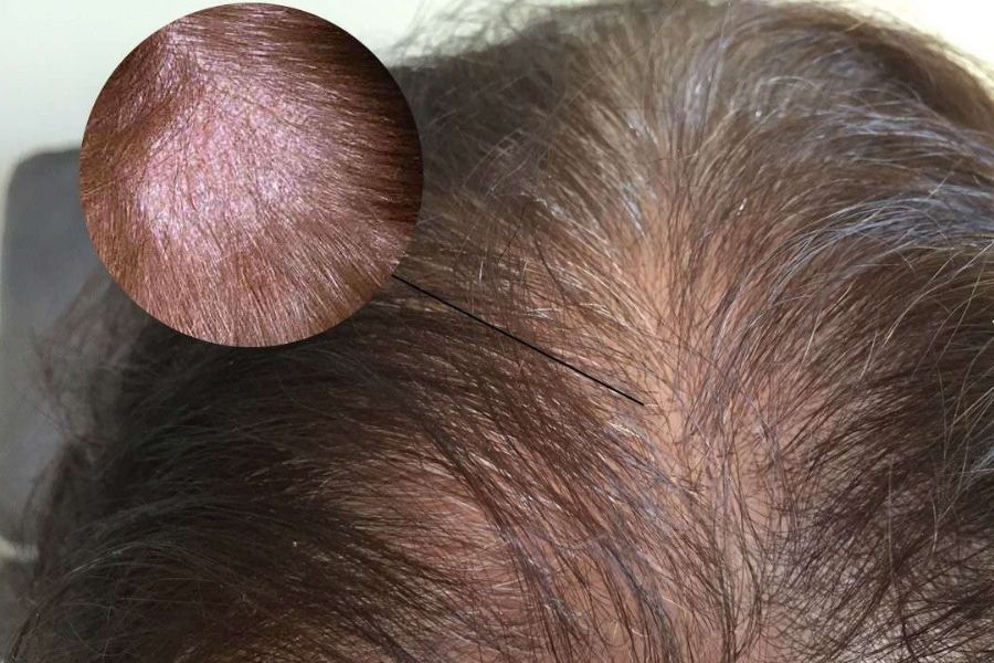 Vấn đề này thường không lây nếu chúng ta biết cách phòng tránh