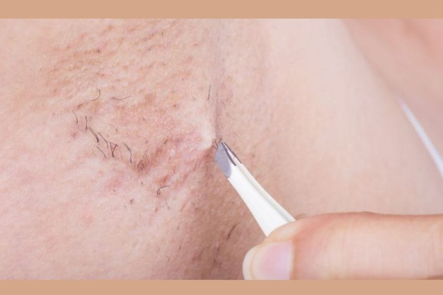 5 cách trị lỗ chân lông to ở nách hiệu quả tại nhà 2 Cạo hoặc nhổ sợi vi-ô-lông thường xuyên là nguyên nhân làm bề mặt vùng cánh sần sùi hơn