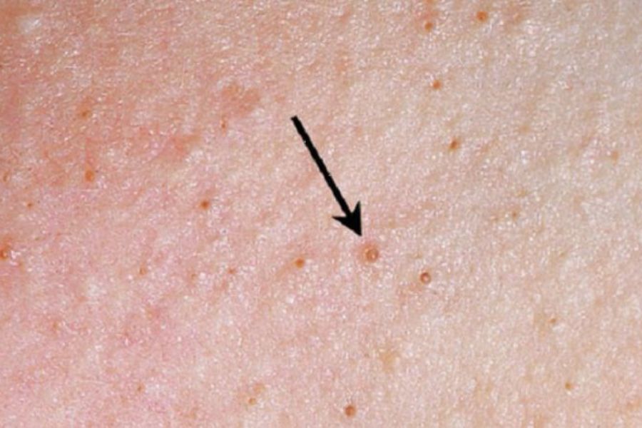 Nguyên nhân gây viêm nang lông chân