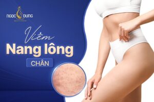 Viêm nang lông chân