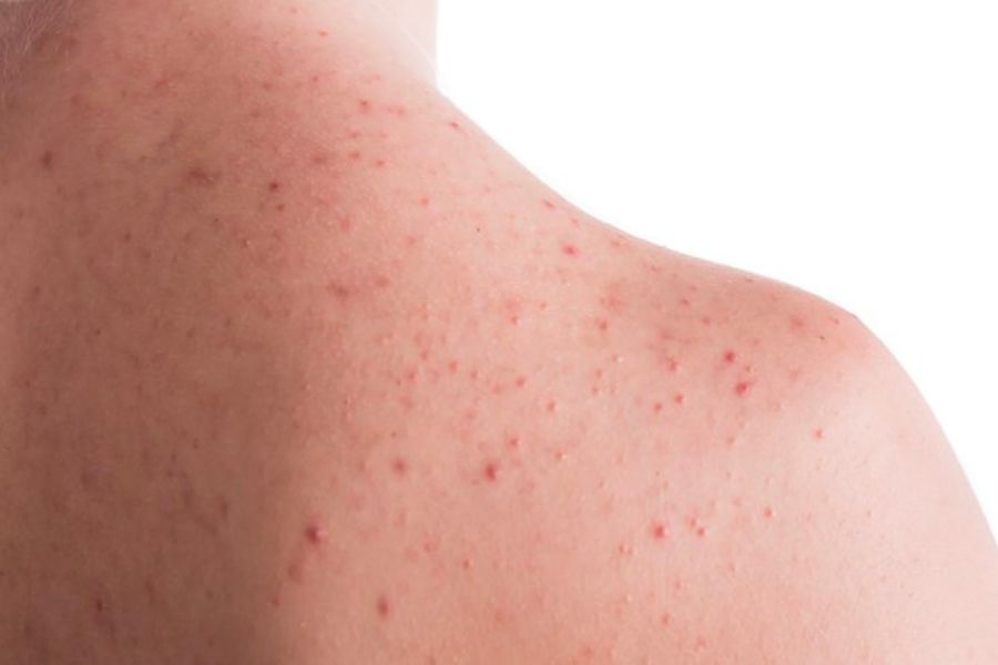 Viêm nang lông có lây không? Các biến chứng khi mắc phải 4 Viêm nang lông có thể lây nếu nguyên nhân là do vi khuẩn hoặc nấm