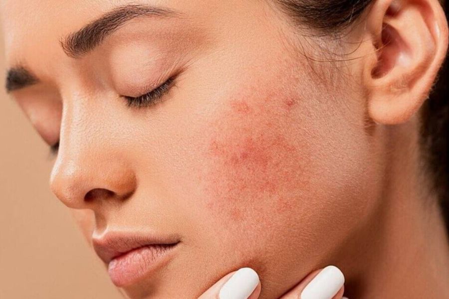 Viêm nang lông mặt: Nguyên nhân và cách điều trị 5 Vấn đề da liễu này cần được xử lý sớm để tránh để lại sẹo