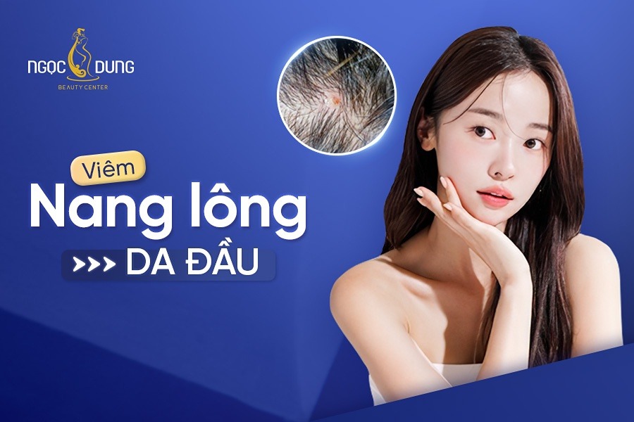 Viêm nang lông da đầu