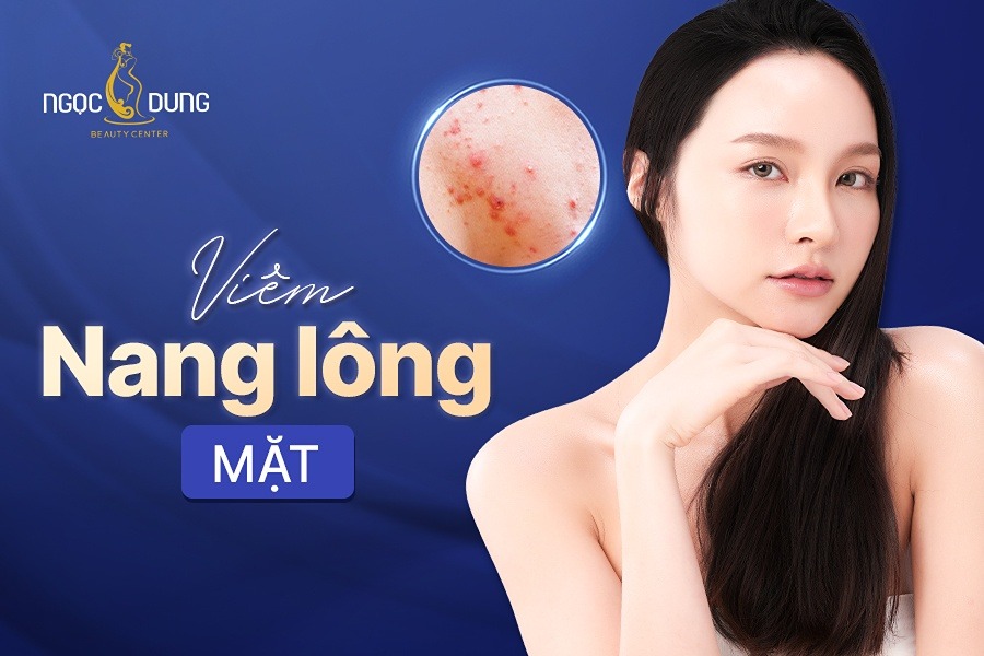Viêm nang lông ở mặt