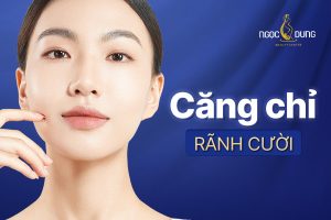 căng chỉ rãnh cười