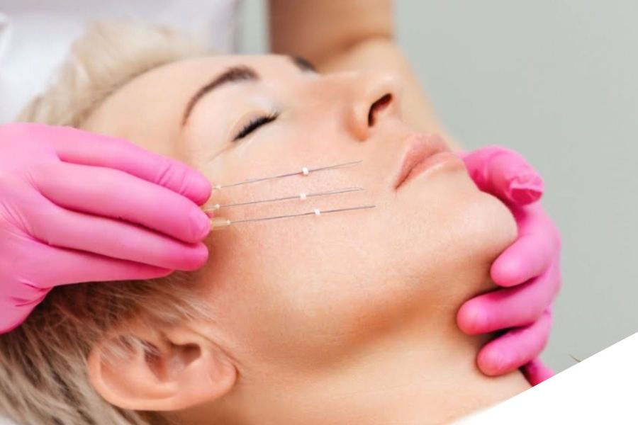 Căng chỉ rãnh cười là một trong những giải pháp trẻ hóa da phổ biến hiện nay