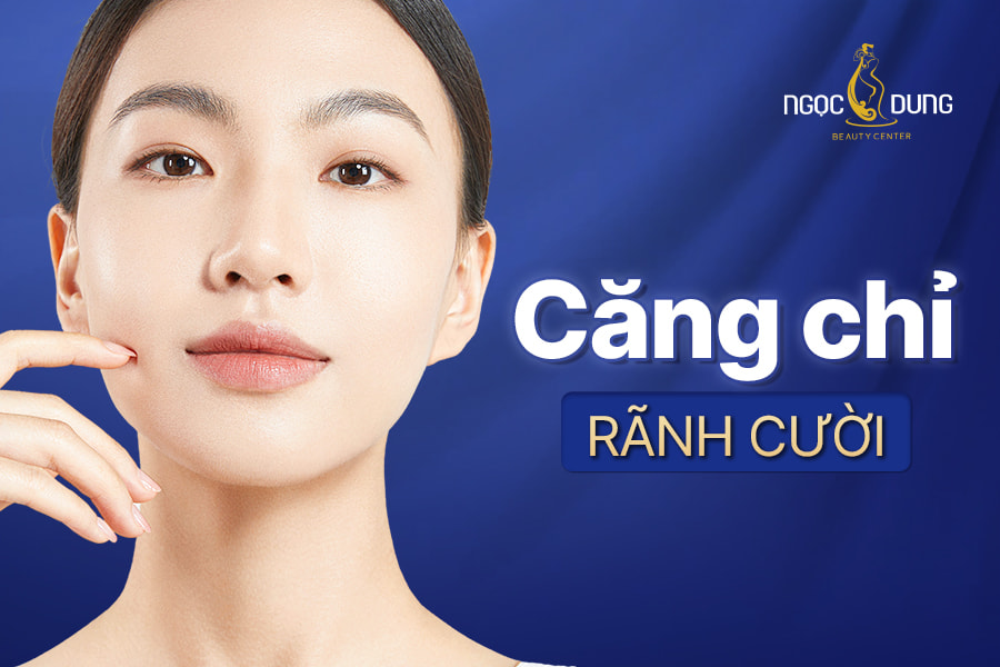 căng chỉ rãnh cười