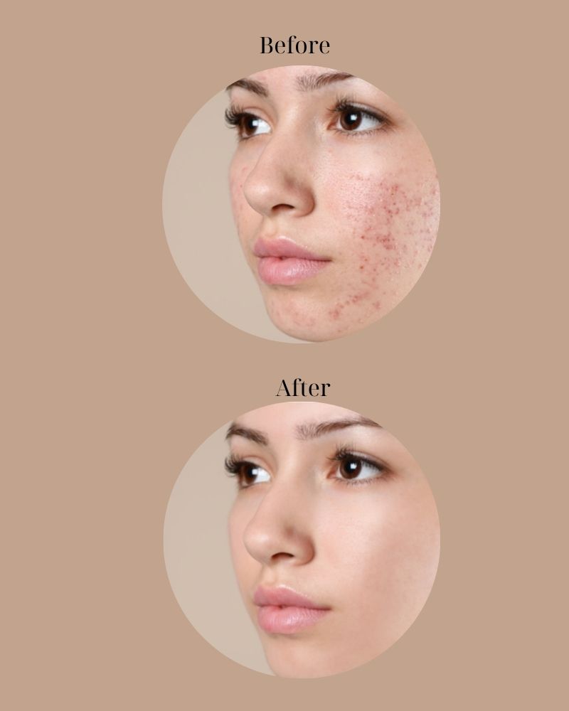 Giảm đến 85% tình trạng mụn sau liệu trình