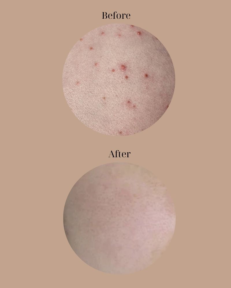 Kết quả trị viêm nang lông tại TMV Ngọc Dung