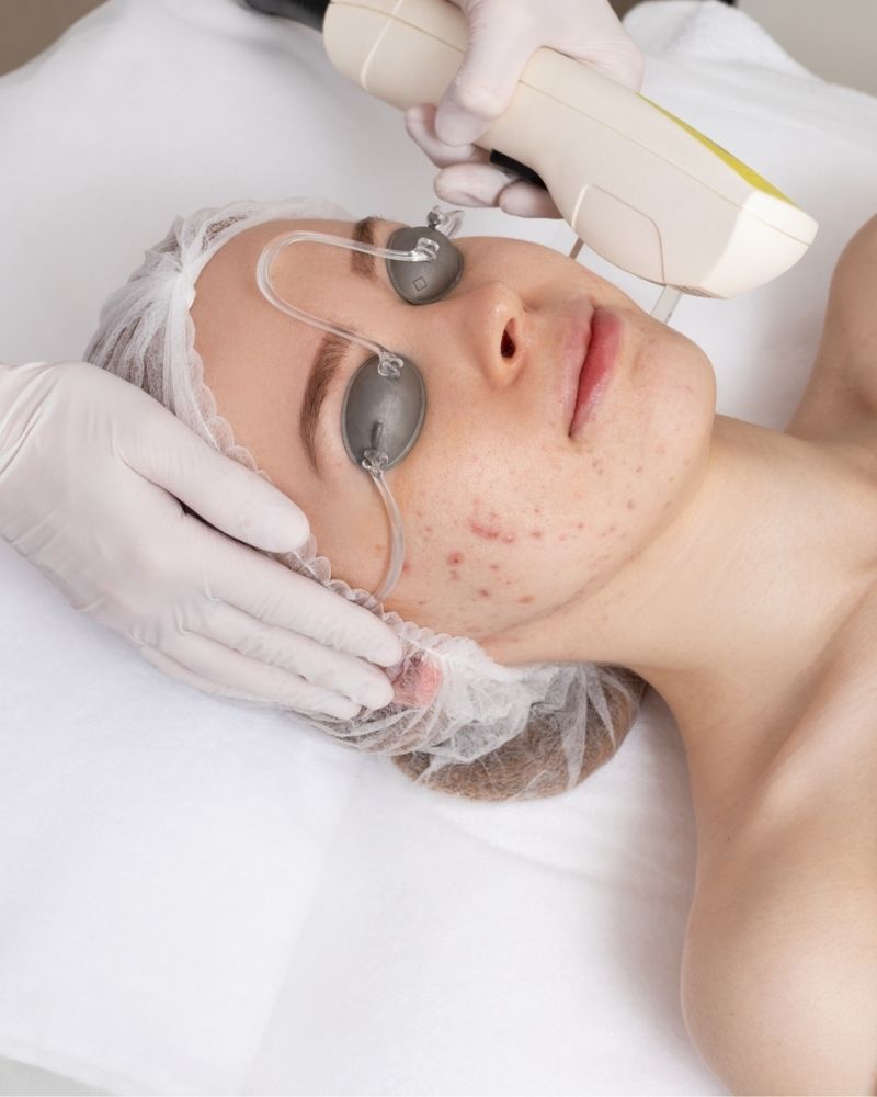 Laser tác động chính xác vào từng nốt mụn