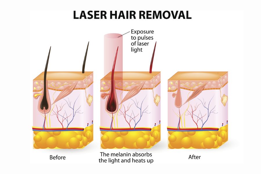 Cơ chế triệt lông của tia Laser