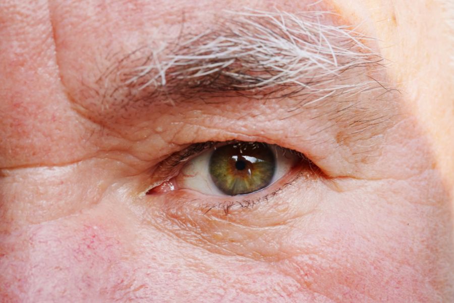 Tuổi tác, lão hóa là nguyên nhân chính gây tình trạng lông mày bạc