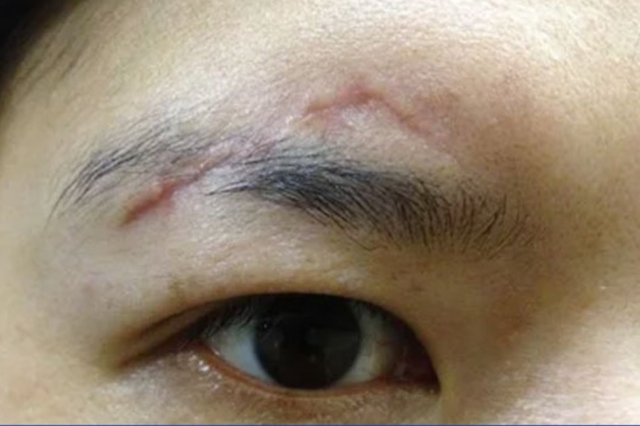 Sẹo có thể tồn tại vĩnh viễn, làm ảnh hưởng đến tính thẩm mỹ của khuôn mặt