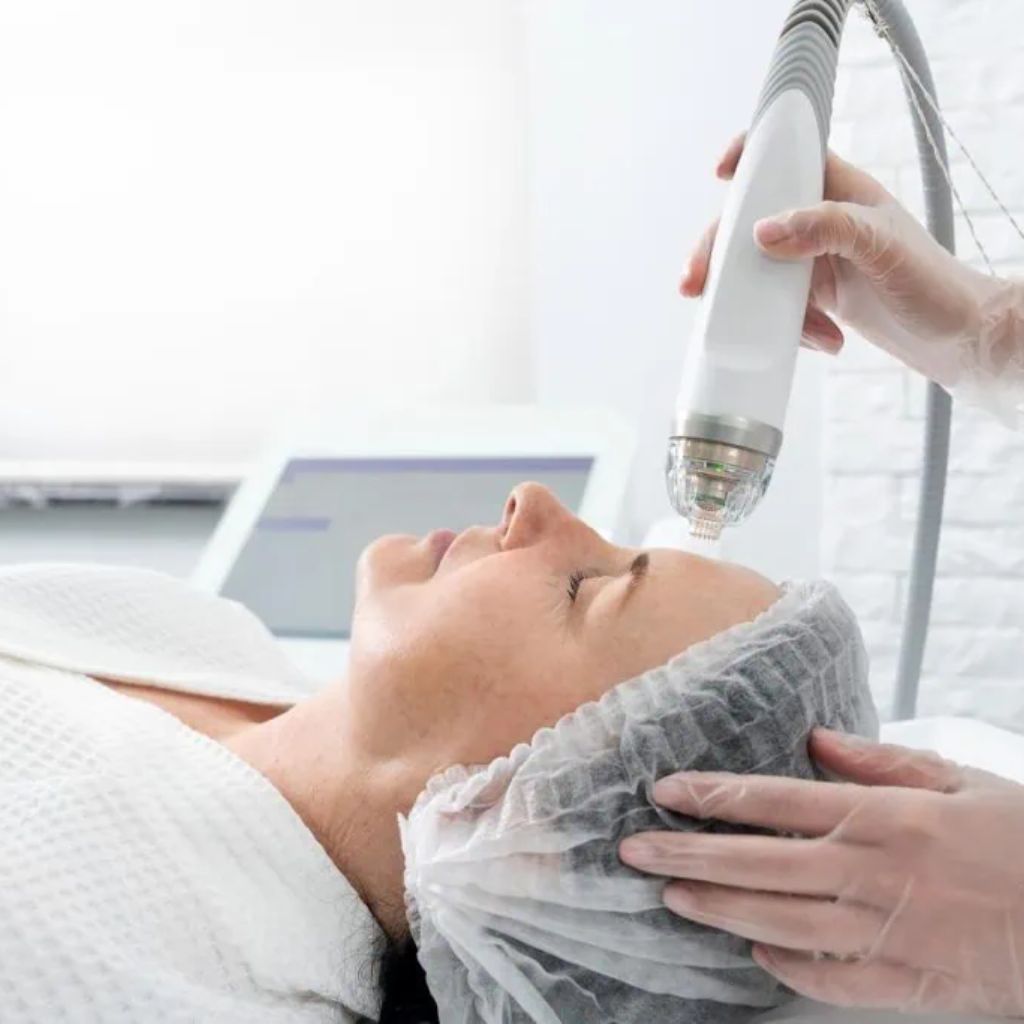 Trị mụn viêm với laser CO2