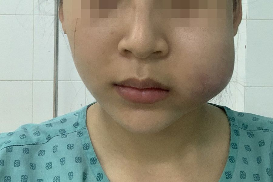 Nguyên Nhân Gây Biến Chứng Tiêm Filler Và Cách Phòng Tránh 10 Tình trạng u hạt sau khi tiêm filler